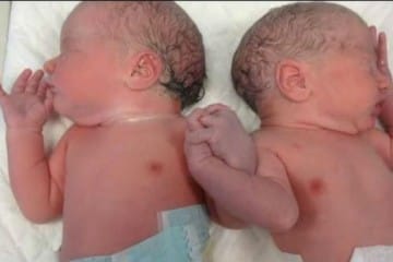 Mellizos se toman de la mano al salir del vientre materno.